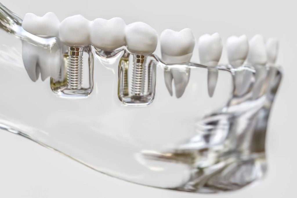 implante dental avanzado